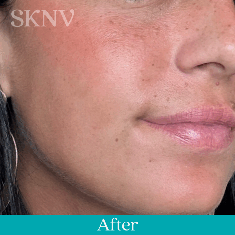 Cheek with smoother texture and reduced irritation after using SKNV’s eczema prescription.