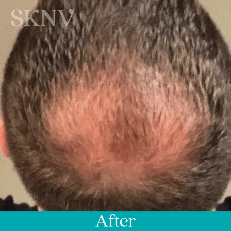 Scalp showing increased hair density and improved coverage after SKNV hair loss treatment.
