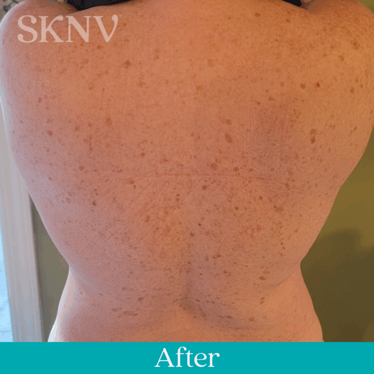 Back with more even tone and reduced dark spots after using SKNV Mekam Emulsion.