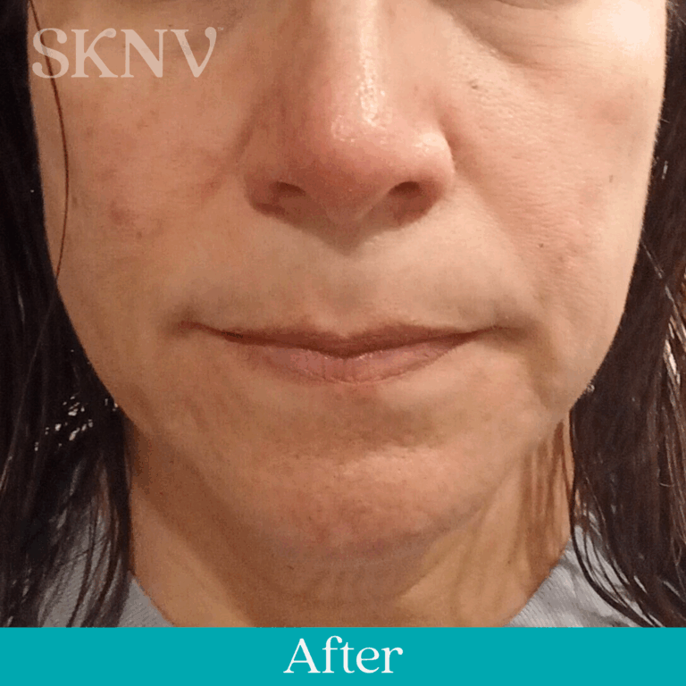 Reduced facial redness and clearer nose and cheeks after using SKNV Rositara Gel.