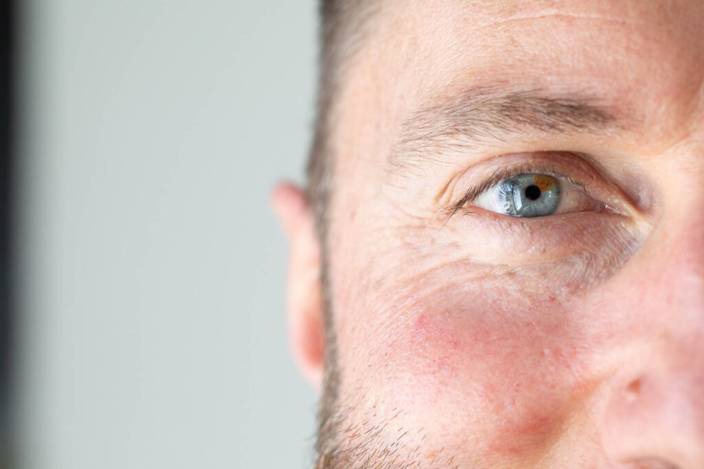 Close-up of facial redness on the cheek near the eye, showing erythema often associated with rosacea and vascular reactivity.